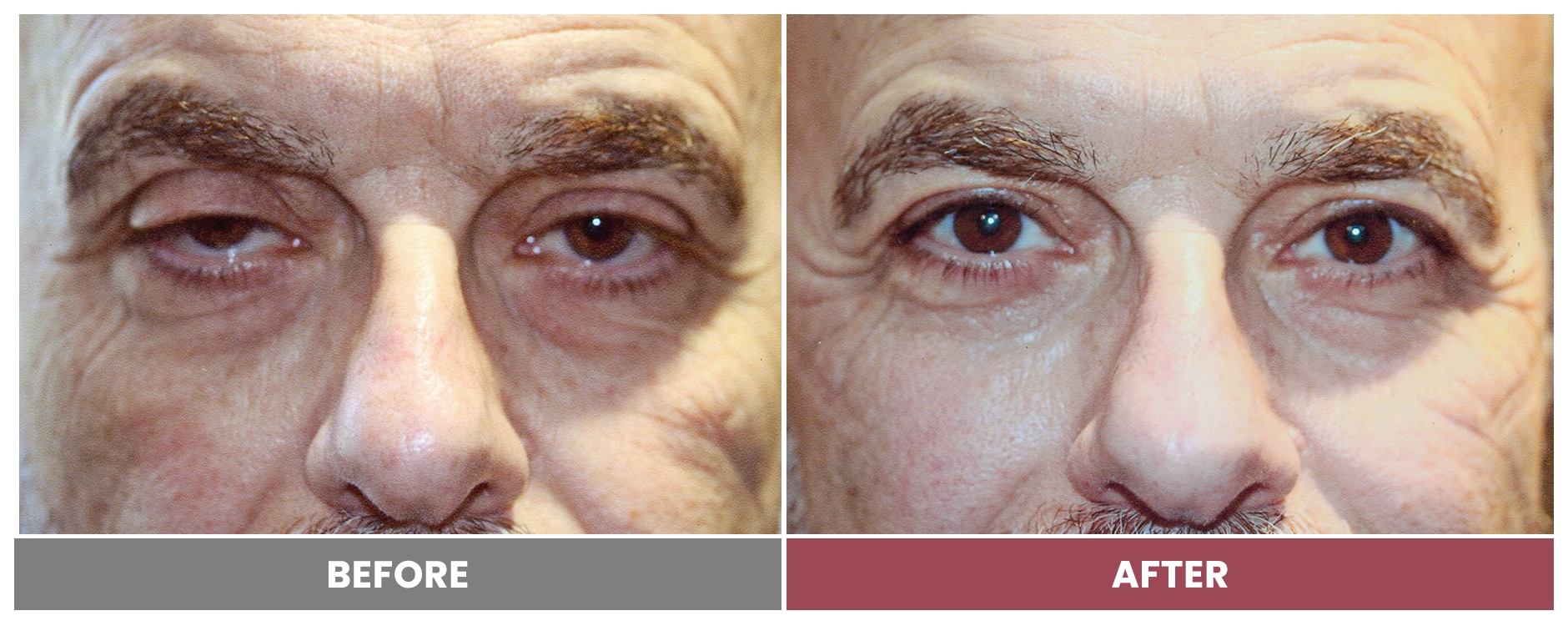 PTOSIS REPAIR - Case 64